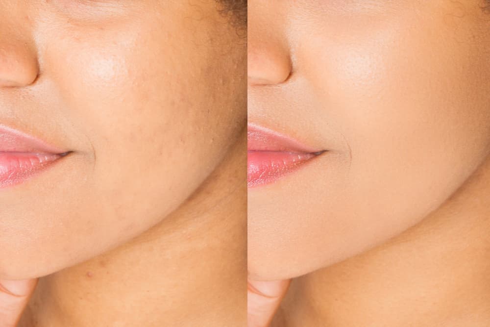 woman with dark spots before and after photo
