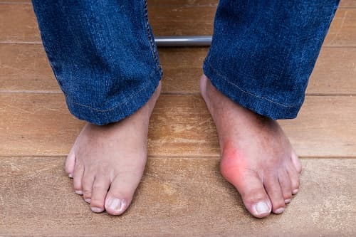immediate-gout-pain-relief