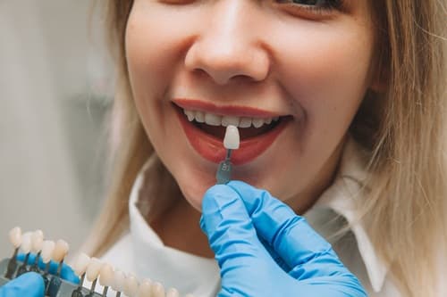 composite-veneers