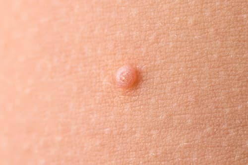 how-to-remove-skin-tags-in-one-night