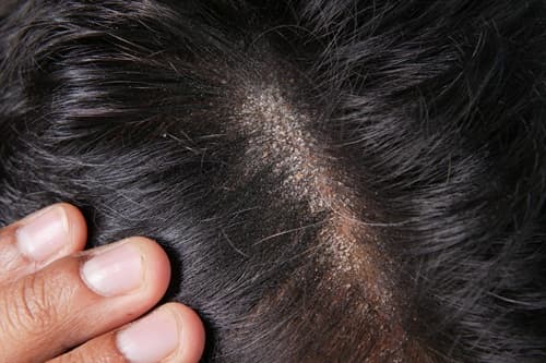 hairline-fracture