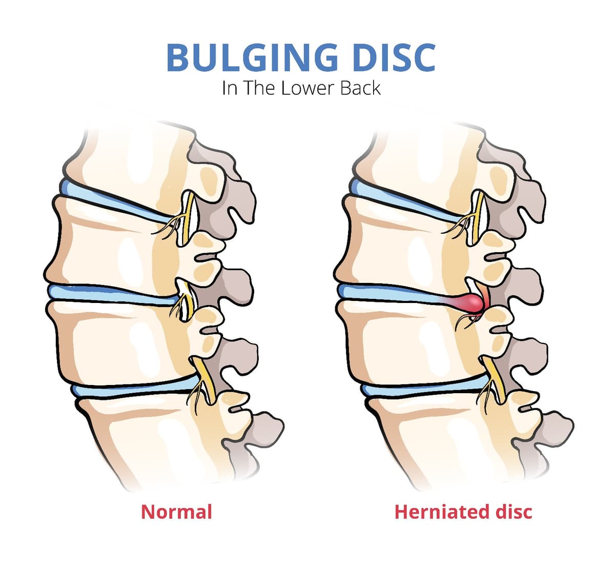 disc bulge treatment|slip disc|diffuse disc bulge