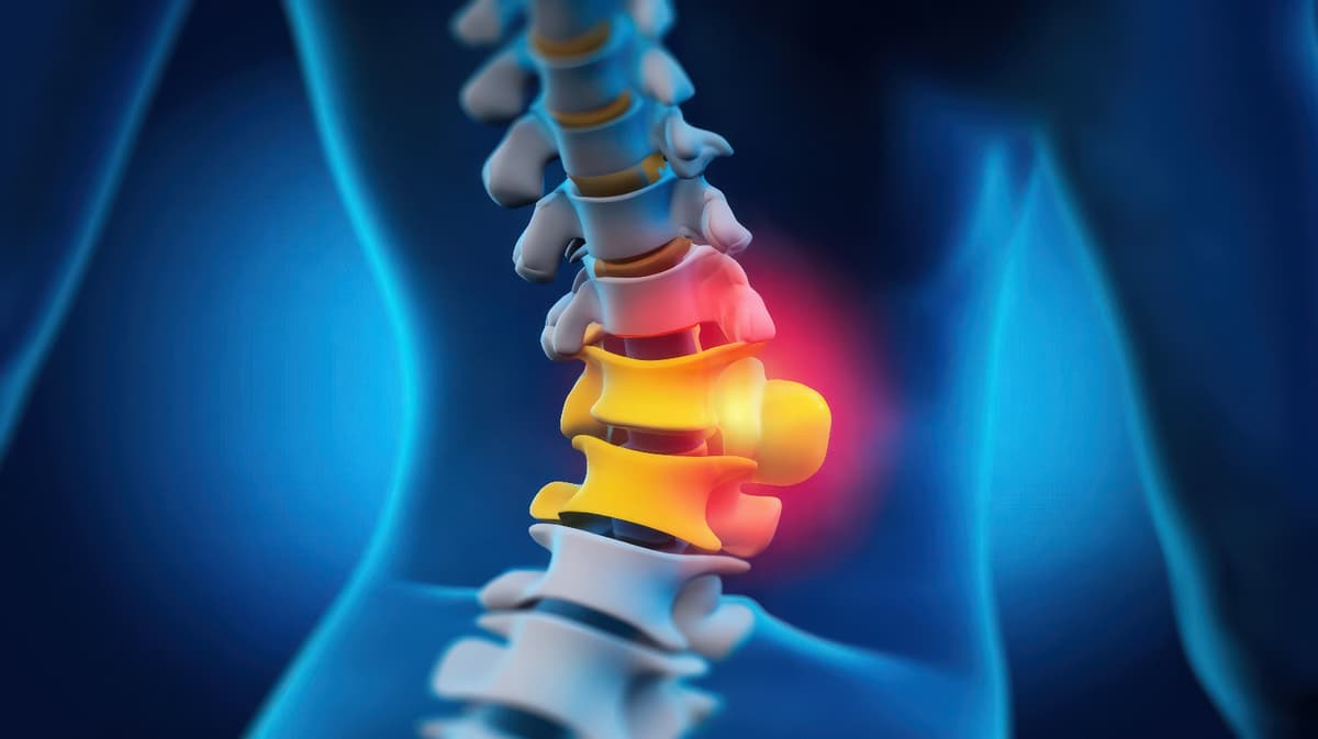 Signs a Herniated Disc Is Healing