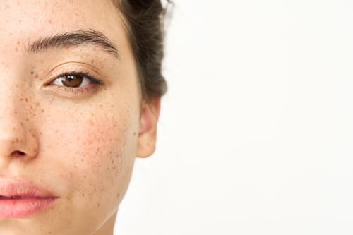 black-dots-on-face-how-to-remove