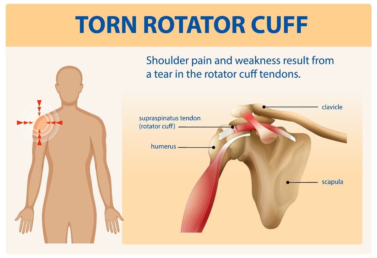 rotator cuff injury test; rotator cuff pain recovery time; rotator cuff tear treatment